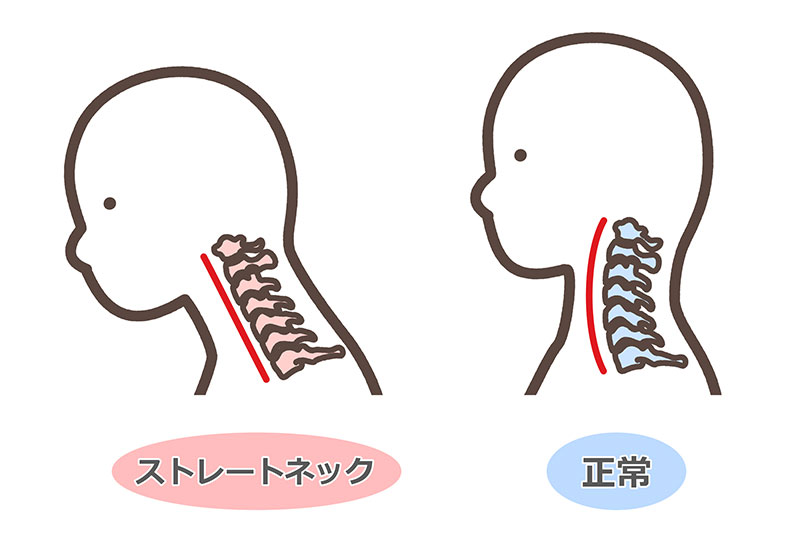 ストレートネック